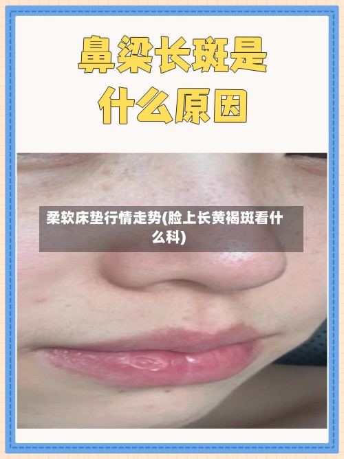 柔软床垫行情走势(脸上长黄褐斑看什么科)