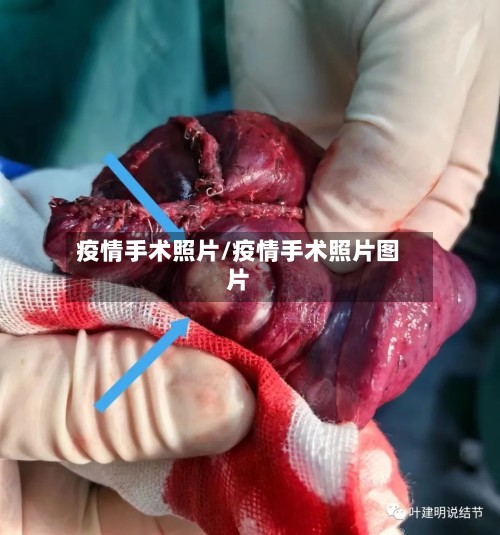疫情手术照片/疫情手术照片图片-第2张图片